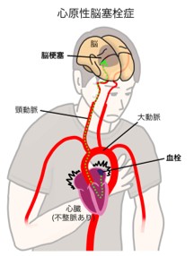 心原性脳塞栓症