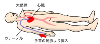 カテーテル