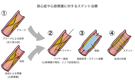 狭心症,心筋梗塞,ステント治療