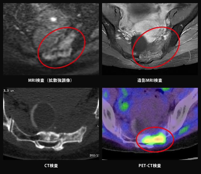 治療 仙骨 骨折