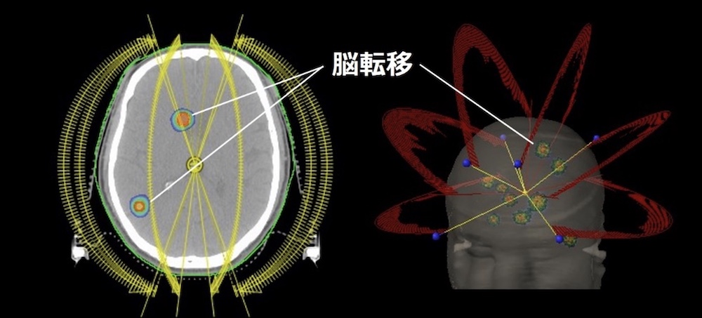 ９個の多発脳転移に対するVMAT