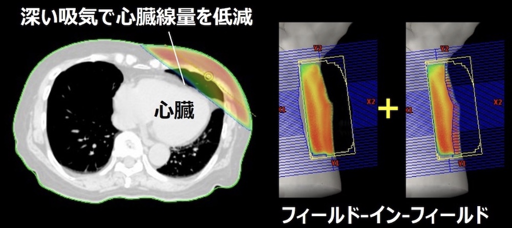 深吸気呼吸静止下による左乳房温存照射