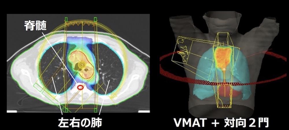 食道癌に対するハイブリッドVMAT