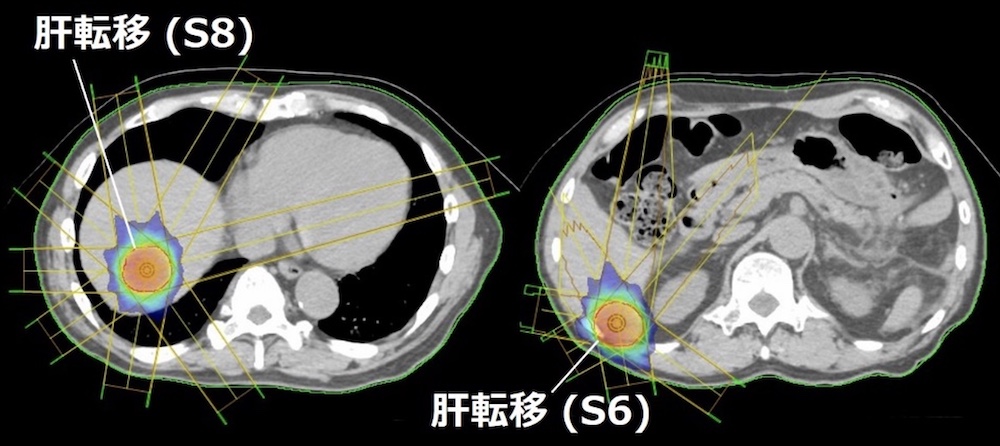 ２個の肝転移に対する３次元原体照射