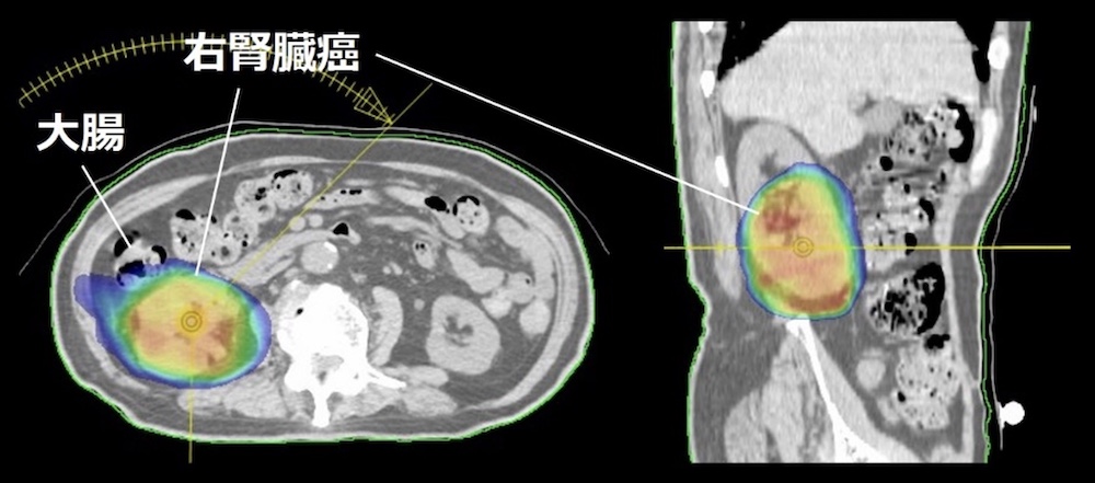 腎臓癌に対するVMATによるSBRT