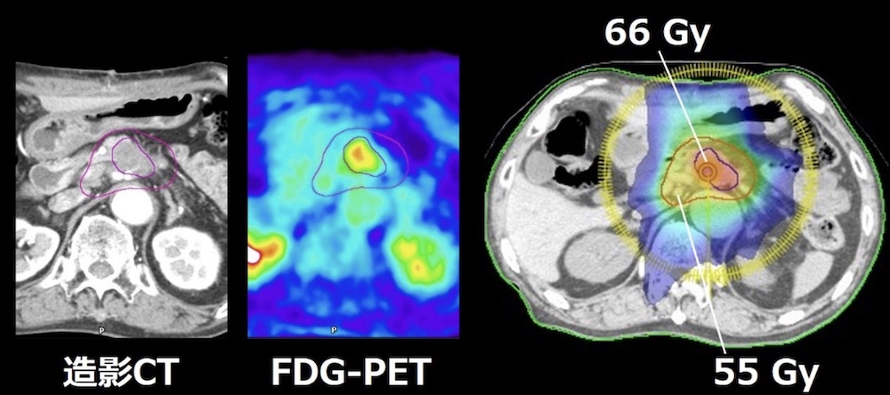 膵臓癌に対するVMAT