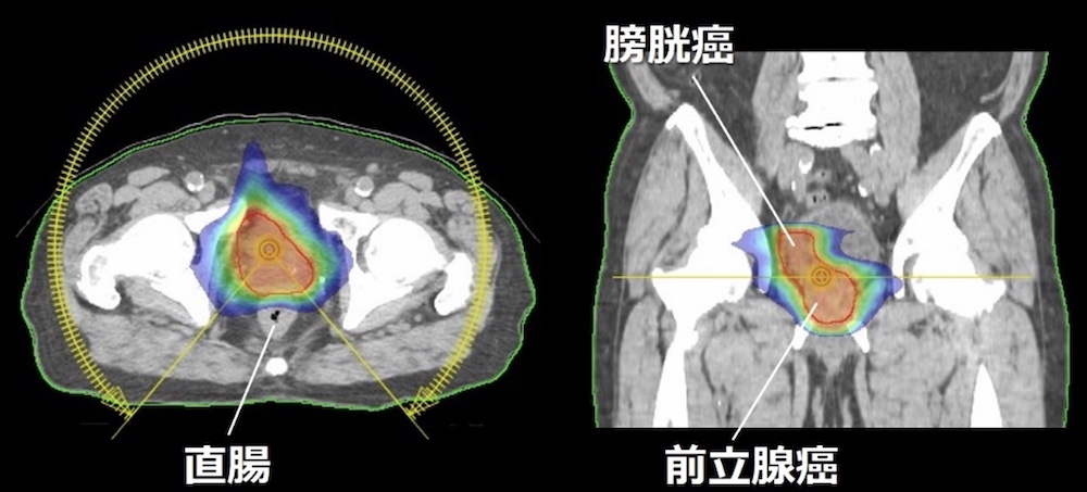 前立腺癌と膀胱癌に対するVMAT