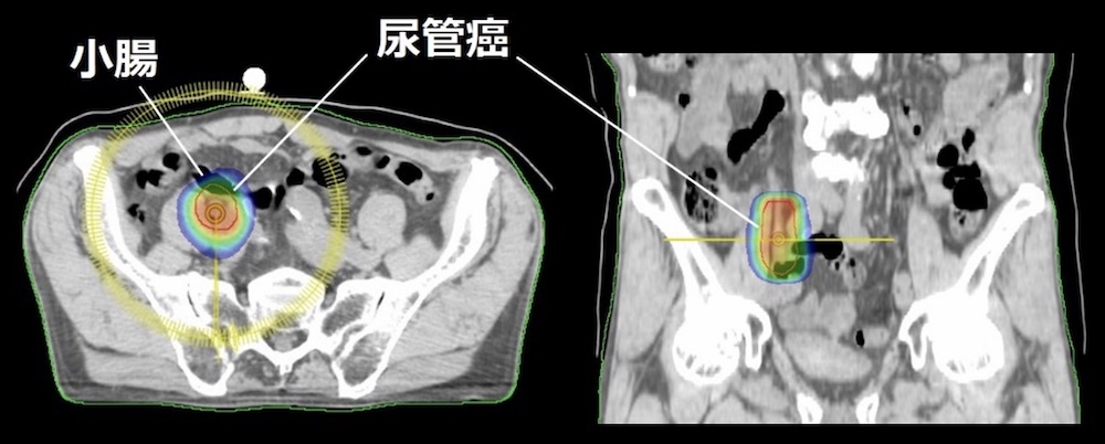 小腸が隣接した尿管癌に対するVMAT