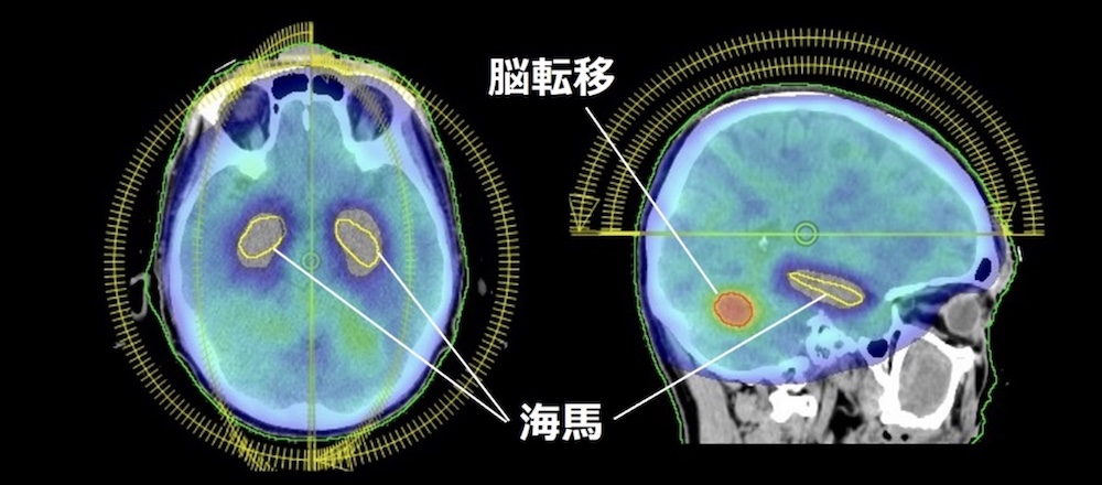 海馬を回避した全脳照射と脳転移に対するVMAT