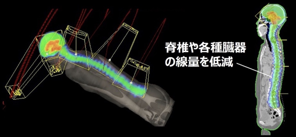 全脳と全脊髄に対するVMAT