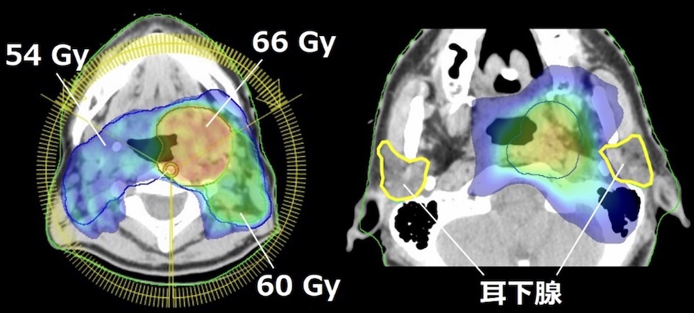 耳下腺線量を軽減した中咽頭癌に対するVMAT