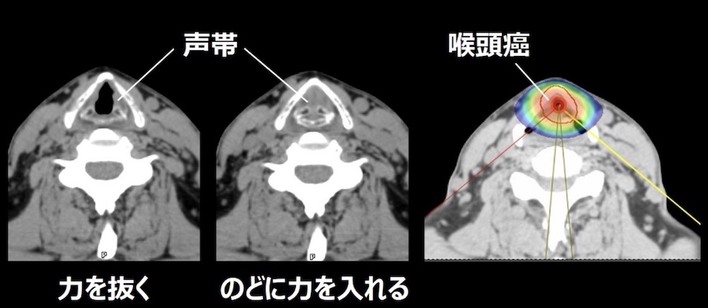 声帯の動きと喉頭癌に対する回転原体照射