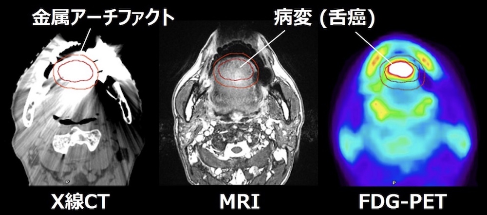 MRIやPETを利用した舌癌の病変抽出