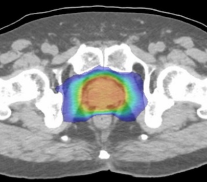照射技術のイメージ