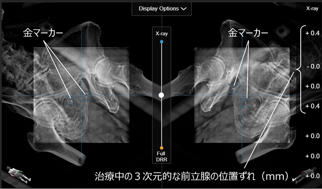 ExacTrac Dynamicシステムによる前立腺追跡の例