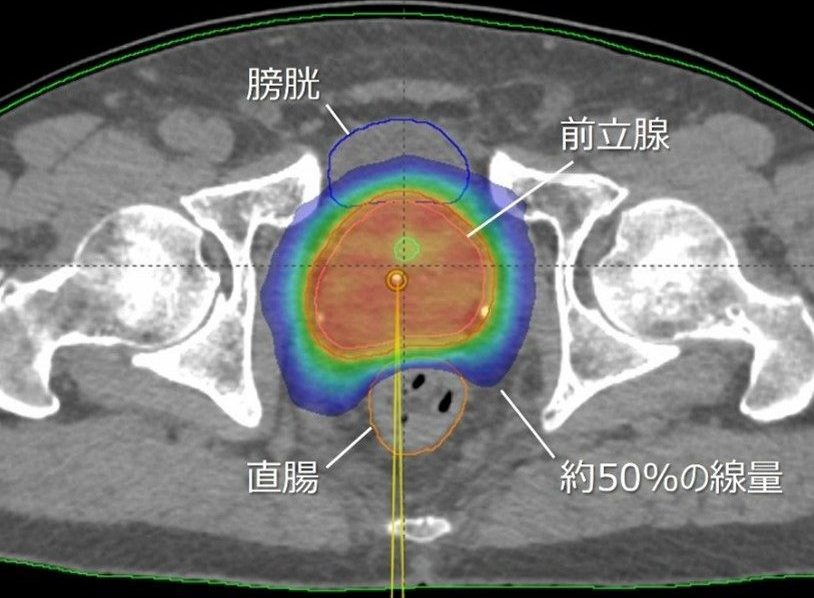 前立腺がんSBRTの治療計画における線量分布