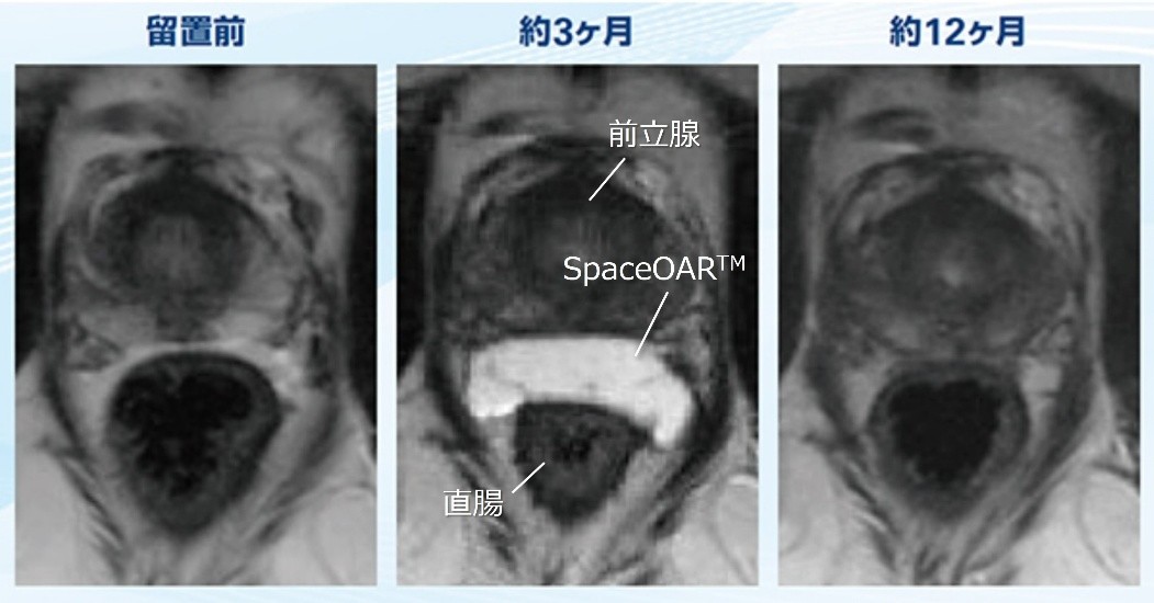 SpaceOAR™留置前後のMRI画像
