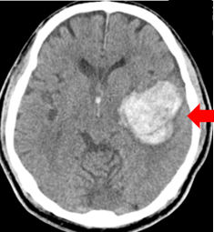 2：脳出血の一例
