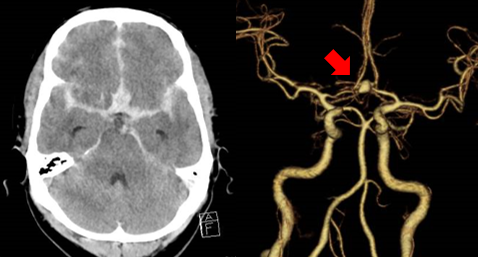 3：くも膜下出血（破裂脳動脈瘤）の一例