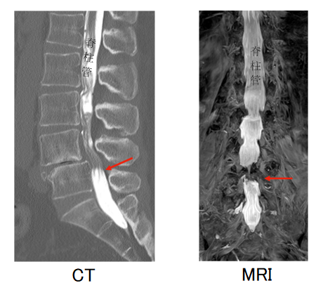 脊柱 管 狭窄 症